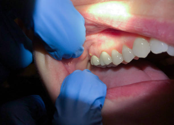 Best Emergency Root Canal Therapy in Napa, CA