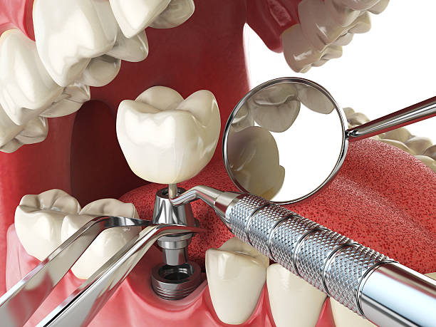 Best Emergency Dental Care for Sports Injuries in Napa, CA